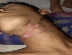 Pengendara Motor Luka Leher Serius Terjerat Kabel Internet
